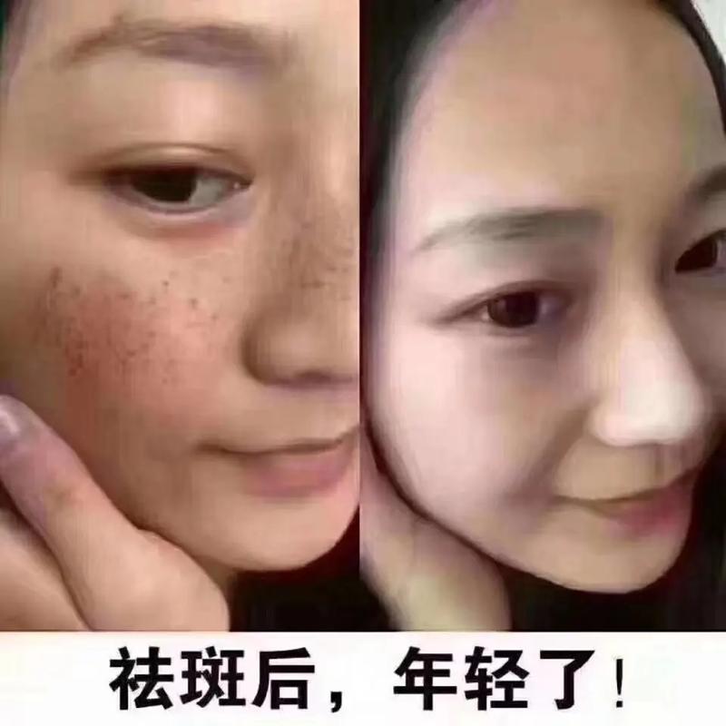 晒斑皮肤镜的表现