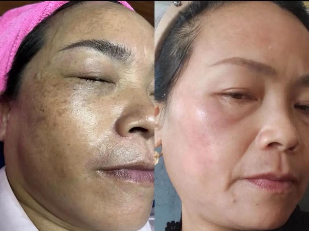丹麦人有雀斑吗