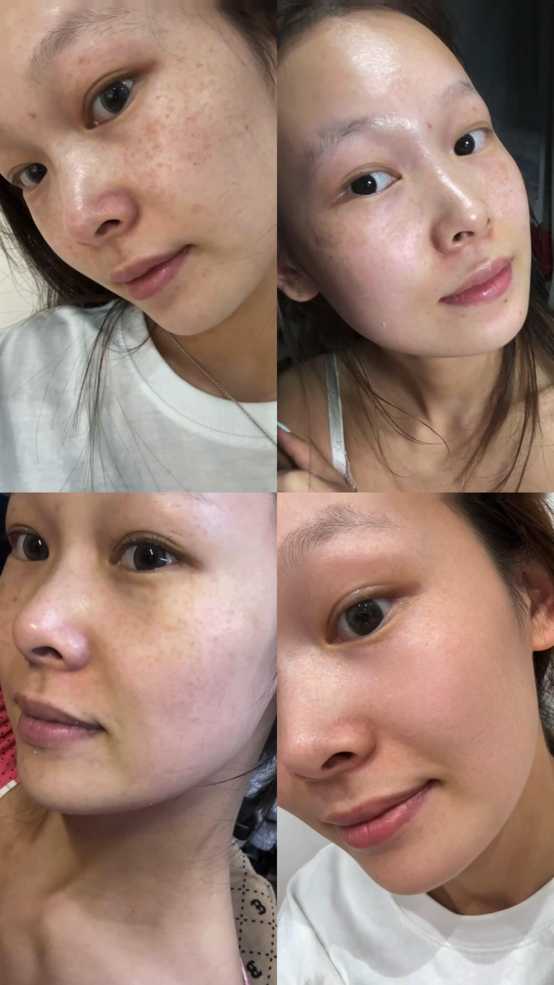  雀斑一次性能做干净吗