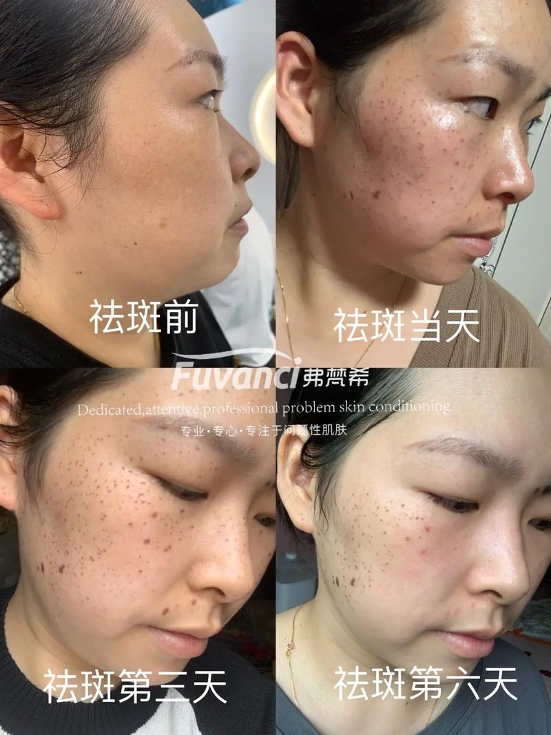 要是点雀斑有效吗