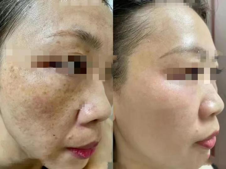 医用烟酰胺儿童面部雀斑