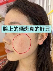 长晒斑怎么去除方法