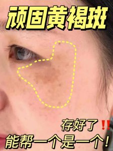 欧洲人为什么会有雀斑